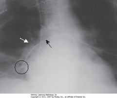 SWAN-GANZ - TIP TOO PERIPHERAL 
• Catheter directed toward R pulmonary artery (SBA)
• Hilar shadow - tip should be within 2 cm of hilar shadow (SWA)
• Tip of catheter - in peripheral branch of R descending pulmonary artery (BC)
• Could cause pulmonary infarct or pseudoaneurysm