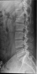 T spine Compression Fx