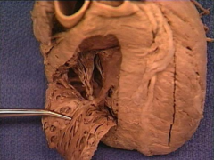 trabeculae carnae of right ventricle