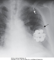 TWIDDLER'S SYNDROME
• SBA: generator rotated on its own axis, curling the leads around
• Retracts tip of electrode from inner wall of RV - pacemaker useless
• SWA: L SC vein - lead retracted into