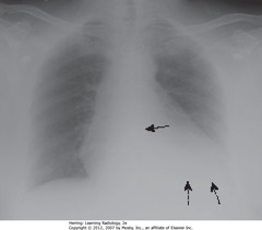 UNDERPENETRATED 
• SBA: spine not visible through cardiac shadow
• DBA: left Hd not visible
• Get lateral CXR to differentiate between artifact of technique & disease