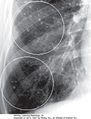 VARICELLA PNA
• WCs: small, discrete nodules in R lung - calcified granulomas in lung interstitium
• Clears w/multiple small calcified granulomas remaining