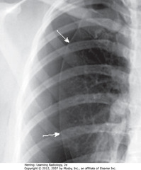 VISCERAL PLEURAL LINE IN PTX
• SWA: visceral pleural line
• Air in pleural space ? pleura retracts to hilum along with collapsing lung
• Visceral pleura visible as thin, white line with air outlining both sides