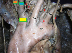 yellow box = brachiocephalic trunk
blue box = right common carotid artery
orange box = r. subclavian artery