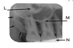 zygomatic process of maxilla