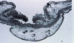 entamoeba histolytica
(flask shaped ulcer)