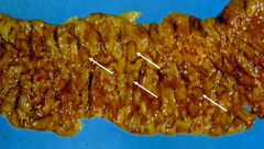 entamoeba histolytica
(intestinal ulcer)