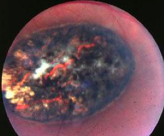 toxoplasma gondii
(macular lesion of retina)
